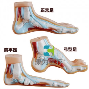 “康為醫(yī)療”正常足、扁平足、弓型足模型