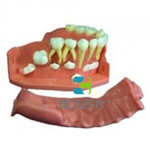 “康為醫(yī)療”牙列發(fā)育模型B